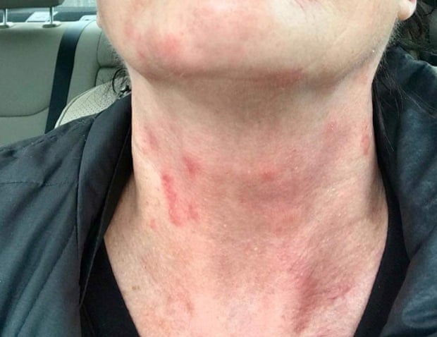 'Chemical burns': Delta flight attendants say new uniforms cause rashes